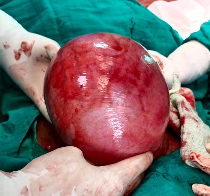 जिला चिकित्सालय दुर्ग में जशपुर की महिला का सफल ऑपरेशन: बच्चेदानी से 3 किलो का फाइब्राइड निकाला गया